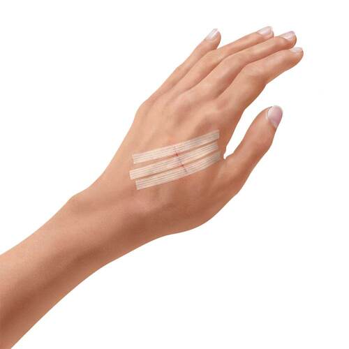 Ratioline Wundverschlussstreifen steril 2 Größen - 2