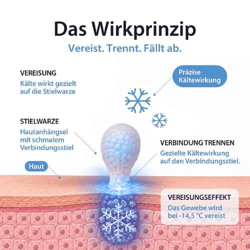 Acetocaustin Stielwarzen Entferner Stift - 4